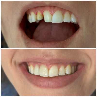 Antes e depois - 03