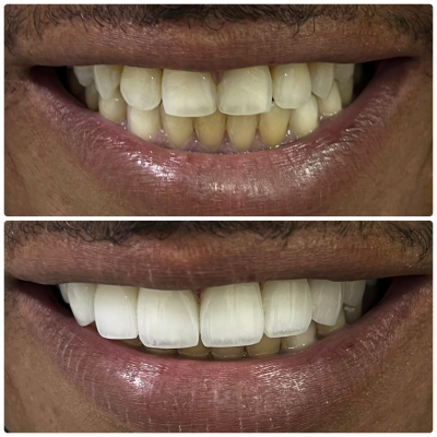 Antes e depois - 06